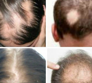 hair loss treatments